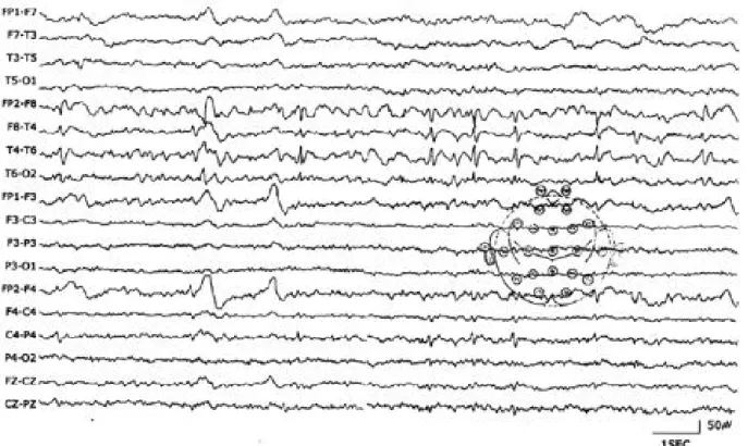 Figure 3. Ictal EEG recording of brief attack arising from stage 2 non-rapid eye movement sleep in a 46-year-old woman (II-6).