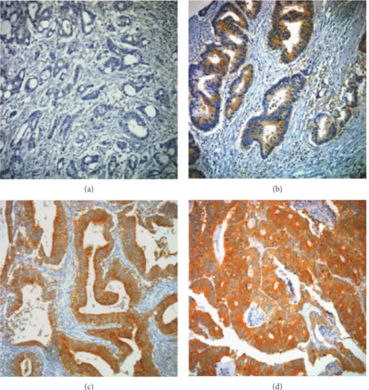 Figure 1: The microphotographs of COX-2 immunostaining by intensity in colorectal cancer: (a) negative, (b) weak, (c) moderate, and (d) strong.