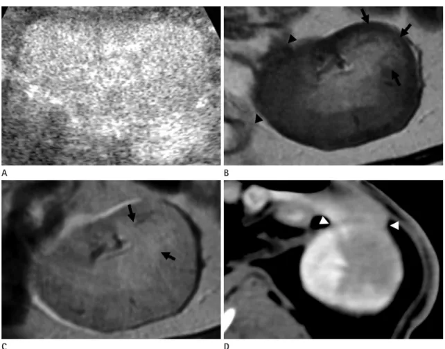 Fig. 2. Acute pyelonephritis involving the left kidney of a rabbit on the third post-inoculation day.