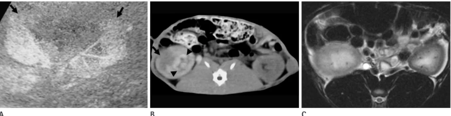Fig. 3. Acute pyelonephritis involving the right kidney of a rabbit on the seventh post-inoculation day.