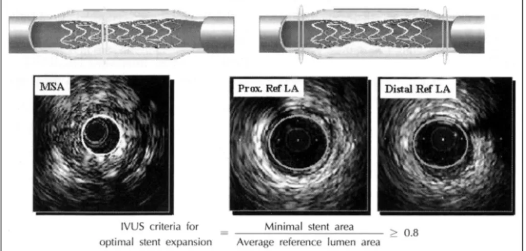 Fig. 1. Intravascular ultrasound criteria for optimal stent expansion. MSA：minimal stent area, Prox