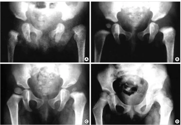 Fig. 2. 14 day old girl suffered from left septic hip arthritis and was taken arthrotomy after 1 day from symptom onset