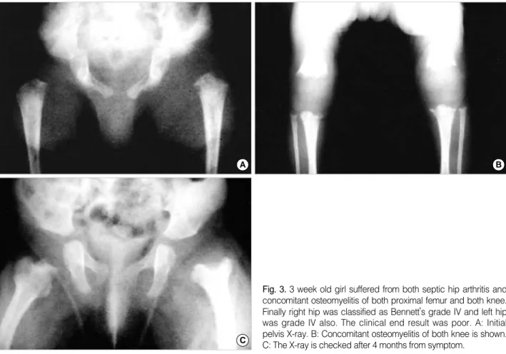 Fig. 3. 3 week old girl suffered from both septic hip arthritis and concomitant osteomyelitis of both proximal femur and both knee.