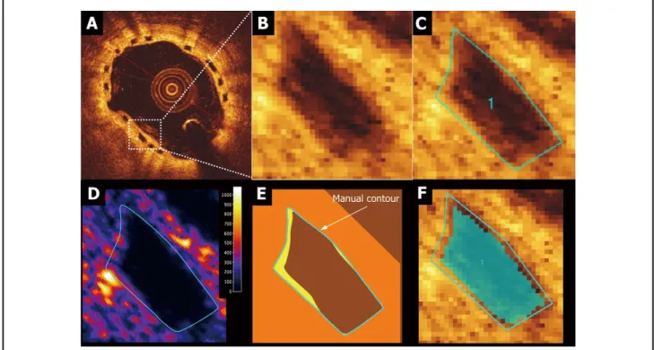 Figure 3.    Strut core for light intensity assessment (region of interest, ROI). (A,B) OCT visualization of Absorb BVS strut consisting  of a core area surrounded by reflective borders that are the interfaces between strut core and lumen or strut core and