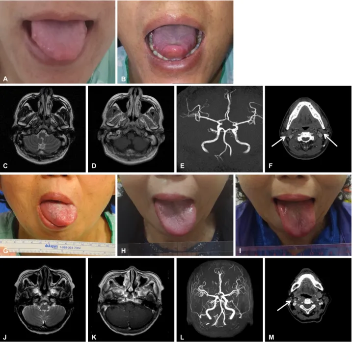 Figure 1. Left hypoglossal nerve palsy. Tongue is deviated to the left during protrusion in case 1 at admission (A) and 2 weeks after  onset (B)