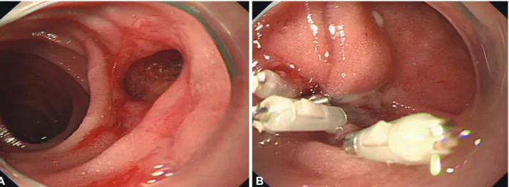 Fig. 3. Primary endoscopic closure of a duodenal wall perforation using endoclips. (A) Image obtained using a cap-assisted endoscope  showing an ovoid perforation