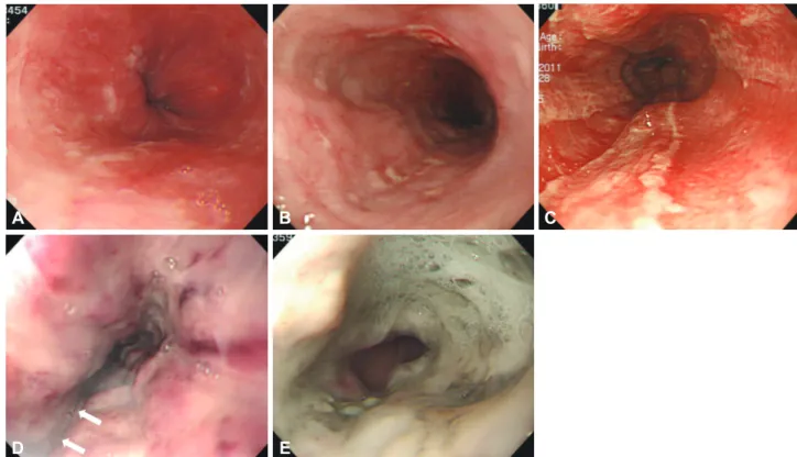 Fig. 4. Endoscopic grading of the caustic gastrointestinal injury. (A) Grade 1 indicates only slight swelling and redness of the mucosa