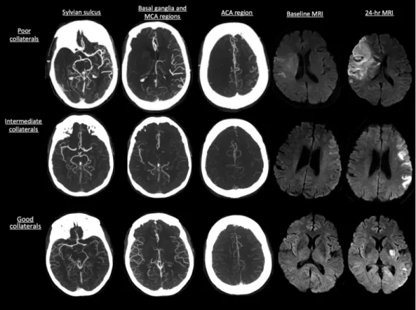 FIG 1. Collateral status on CTA as measured by the rLMC score with baseline and 24-hour infarct volume on MR DWI.