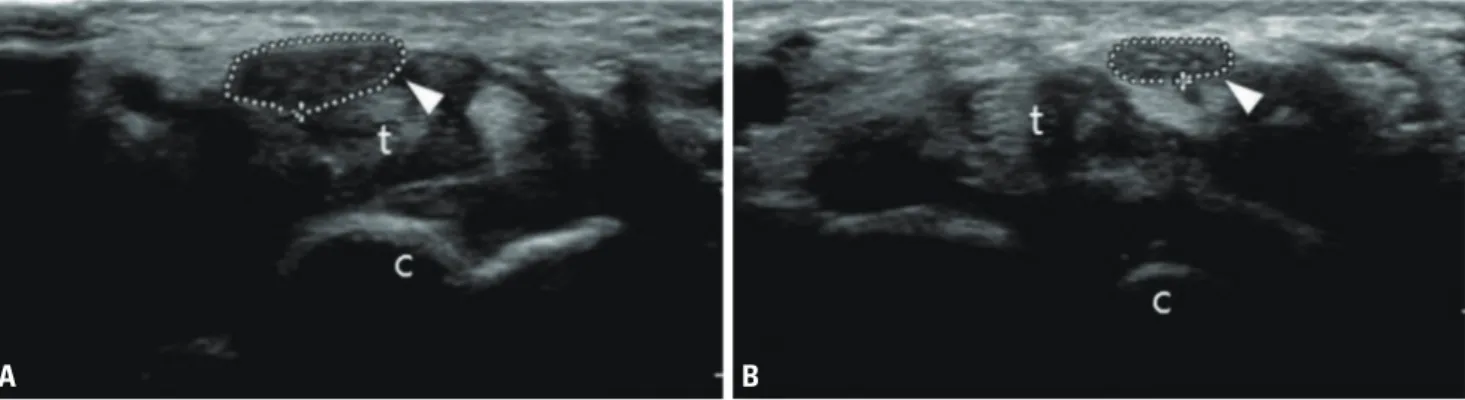 fig. 1. Transverse view of the median nerve at the carpal tunnel of a 51-year-old woman who presented with left-hand paresthesia and muscle wast- wast-ing of the thenar eminence