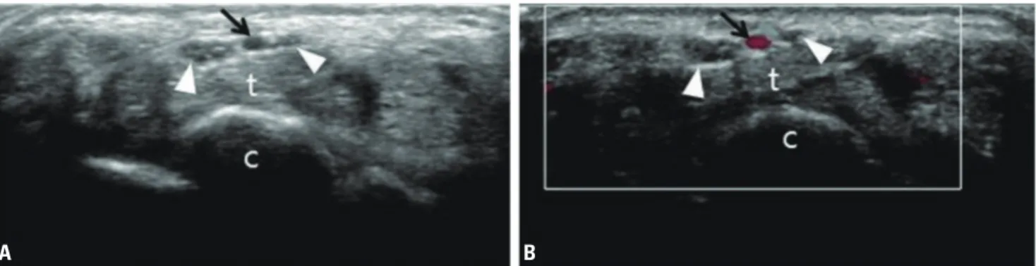 fig. 2. Ultrasonography (A) and color Doppler sonography (B) revealing a bifid median nerve (white arrowheads) and persistent median artery (black  arrows) of the wrist
