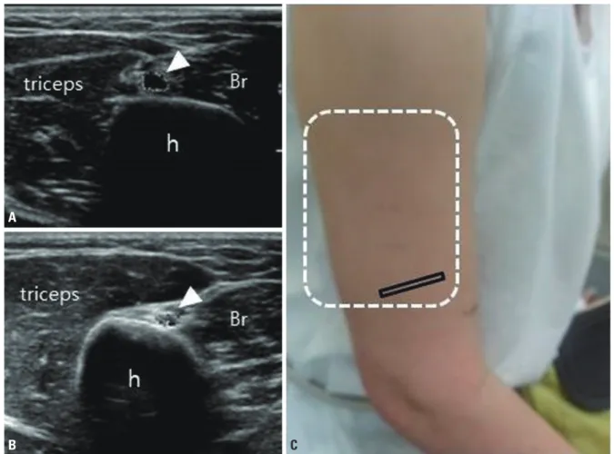 fig. 4. Transverse view of the radial nerve at the spiral groove of a 33-year-old woman who presented with wrist drop of the right arm