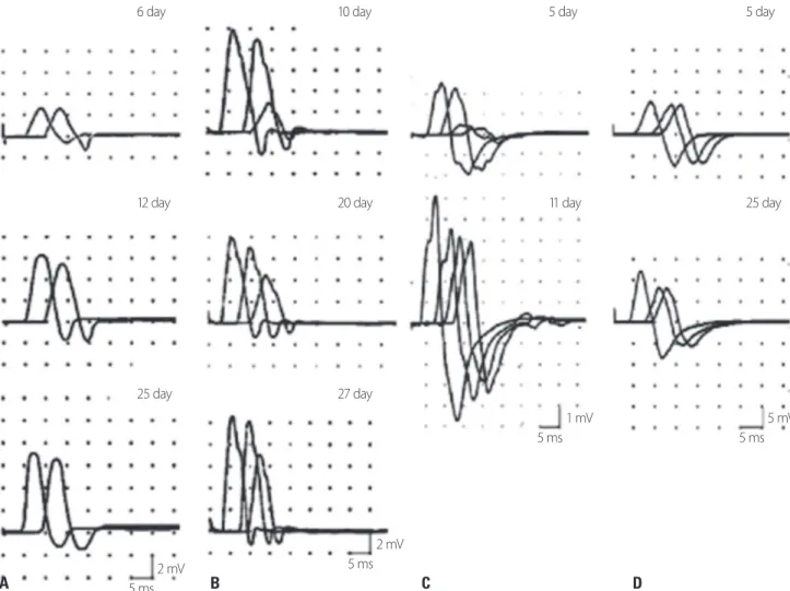 Fig. 1. Types of reversible conduction failure (RCF). (A) Distal RCF in the median nerve