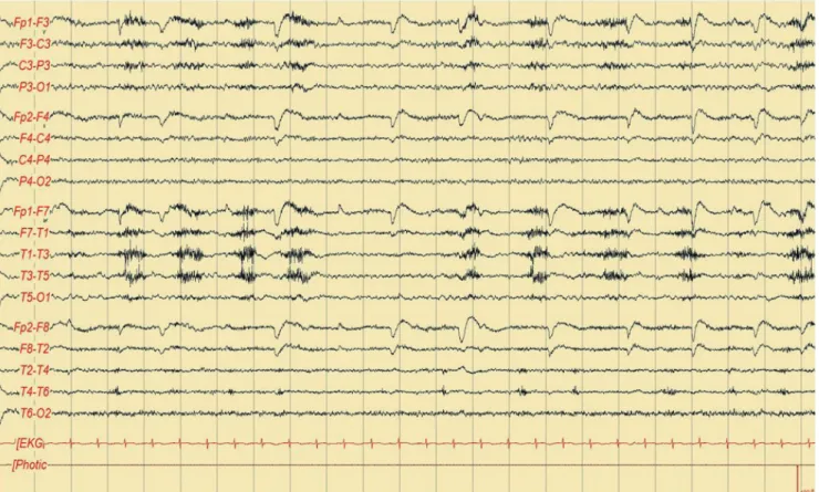 Fig. 3. Follow-up electroencephalography (EEG) performed at 4 hours after the initial EEG showing that the asymmetric rhythmic and quasi-rhythmic  discharges observed in the initial EEG had nearly disappeared