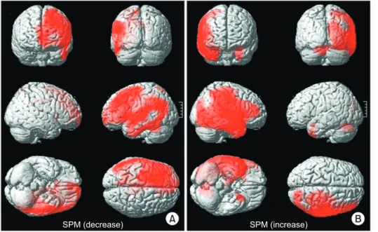 Fig. 2. Three-dimensional render- render-ing,  showing  the  spatial   distri-bution of significant metabolic  changes by Statistical Parametric  Mapping  (SPM)  (p<0.001)