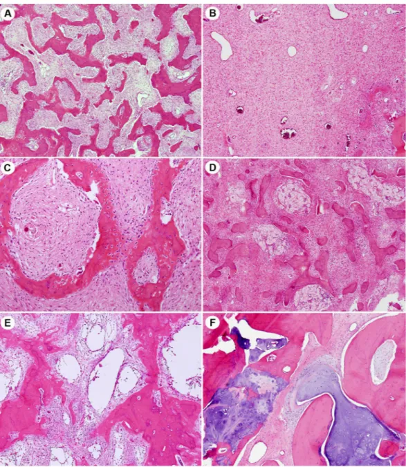 Figure 1.  Histological features of fibrous dysplasia, which contains fibrous tissue with irregular, curvilinear,  and trabeculae of woven bone in varying proportions