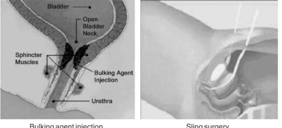 그림 1. Examples of the treatment of urinary incontinence.