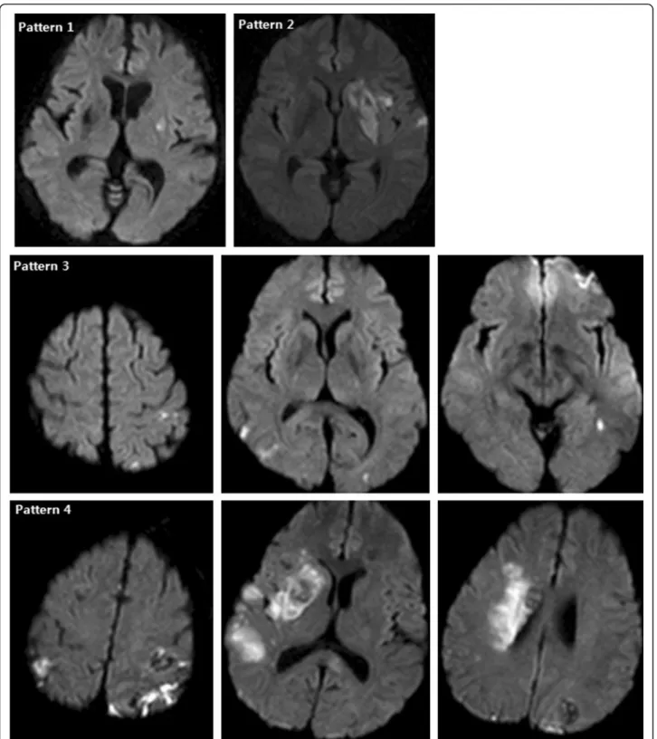 Figure 1 Patterns of acute embolic lesions on diffusion-weighted MRI in patients with infective endocarditis