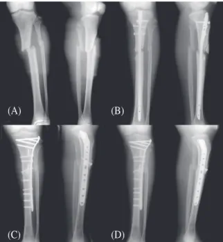 Fig. 1. Poxmial tibia fracture treated with  intramedullary nail shows delayed union and  convert the nail to plate