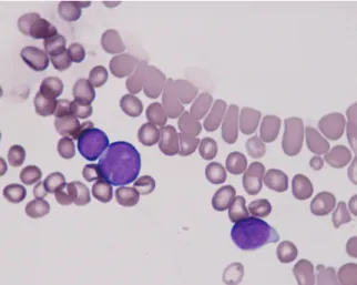 Fig. 1. Bone marrow aspiration before treatment. 