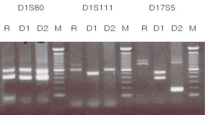 Fig. 4a.  Pre- BMT DNA Test. Used primer: D1S80, D1S111, D17S5, R: recipient, D1: donor cord 1, D2: donor  cord 2, M: marker.