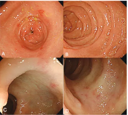 Fig. 3. Upper endoscopy shows multiple erosions in the gastric antrum (A), and friable mucosa in the duodenum (B)