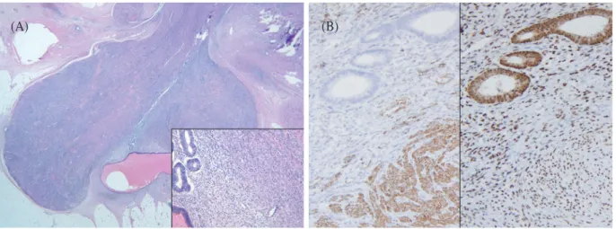 Fig. 2. A 1.5 cm-sized polypoid lesion was present  in the colonic mucosa.