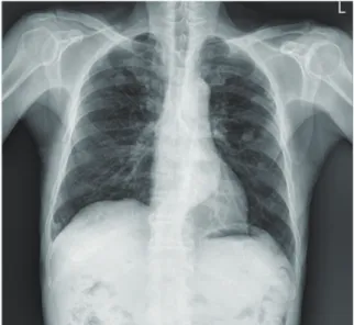 Fig. 2. The radiographic study of chest shows linear  and centrilobular infiltration in right lower lung  field.