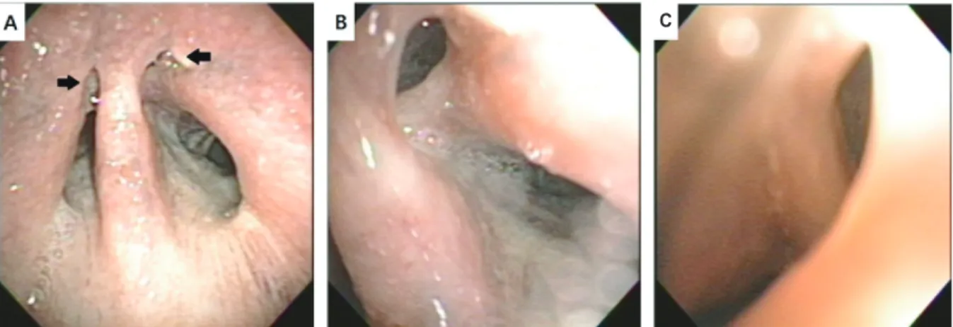 Fig. 5. Follow up contrast enhanced CT scan show 