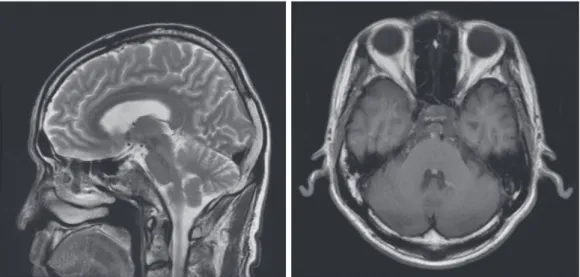 Fig. 2. Brain Magnetic Resonance Image (MRI). There is an about 18×14×17 mm sized osteolytic mass in the  clivus