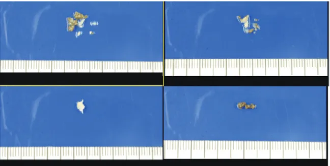 Fig. 4. The fungal ball (asterisk) is consists of narrow fungal hyphae  and surrounded by inflammatory cells  including neutrophils and  lymphocytes
