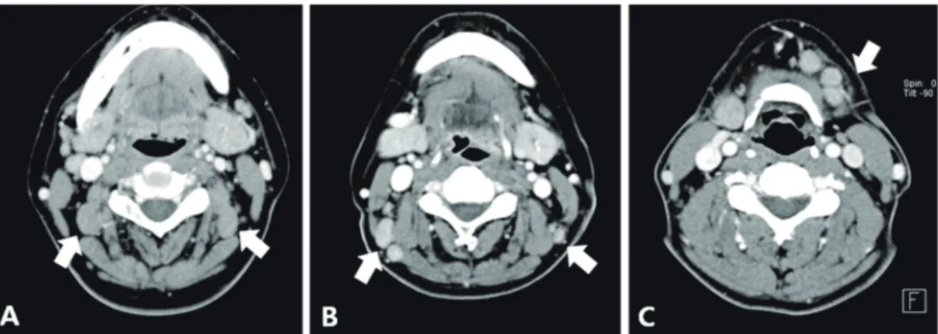 Fig. 1.  Neck computed tomography of the toxoplasmosis patients show multiple enlarged lymph nodes (arrows)