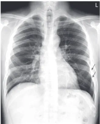 Fig. 1. Initial chest radiograph.