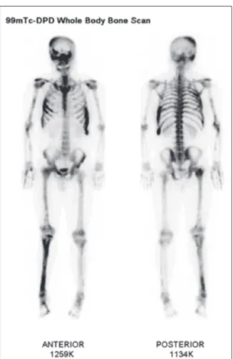 Fig. 2. Initial bone scan.