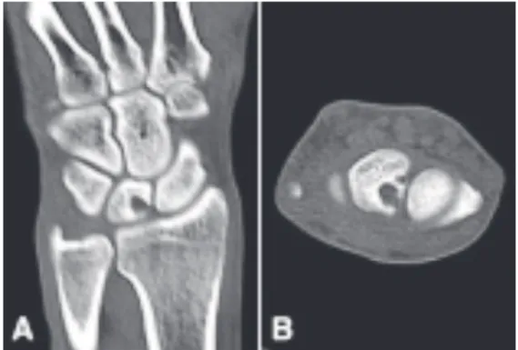 Fig. 2. Computed tomography shows two septated cystic masses with cortical breakage at dorso-radial side of the  lunate (A,B)