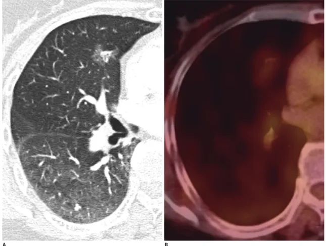 Fig. 2. Adenocarcinoma without EGFR overexpression found in 62-year-old woman.