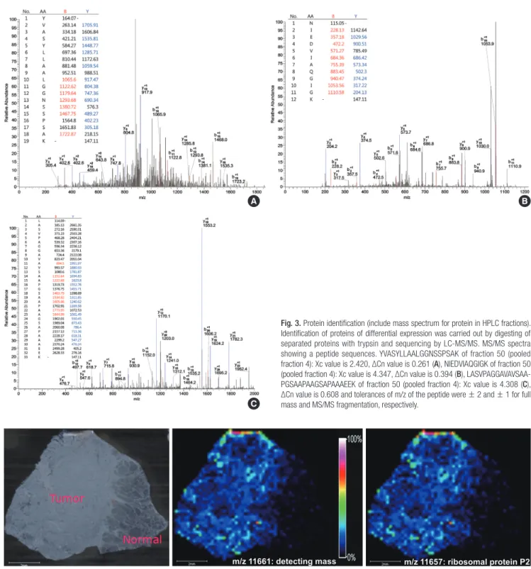 Fig. 4. In imaging mass spectrometry, the distribution of detecting protein (11,661 m/z) displayed high concentration and corresponded with concentration of ribosomal protein  p2 (11,657 m/z) in tumor lesion (∆ mass: 4 m/z).