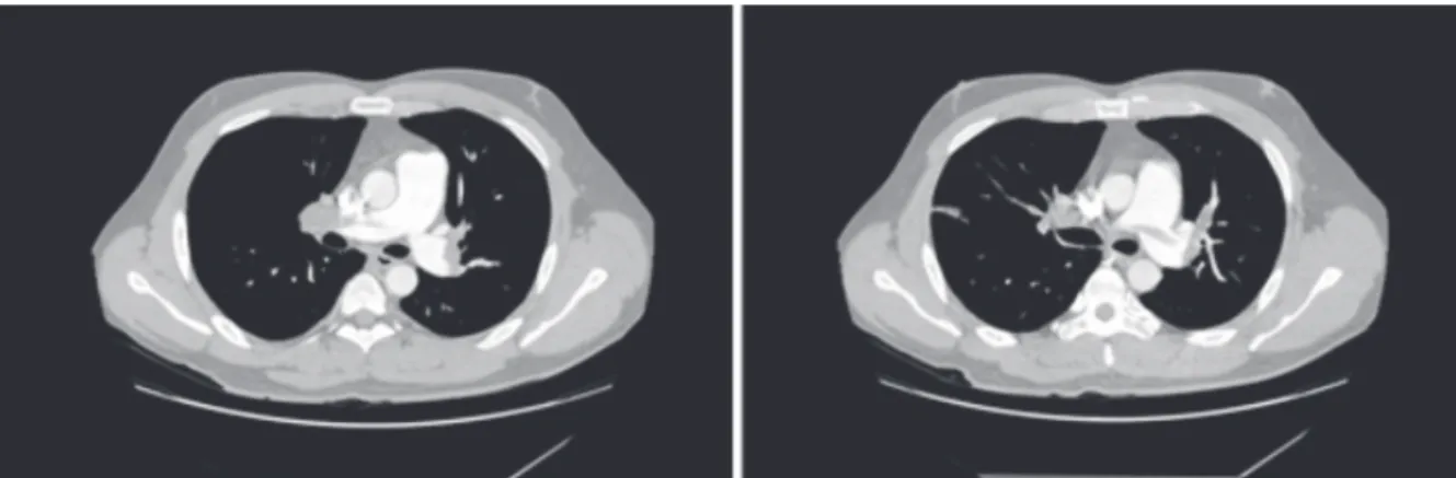 Fig. 1. Chest computed tomography finding. Chest computed tomography showed low density filling defect in  both main pulmonary artery on admission day