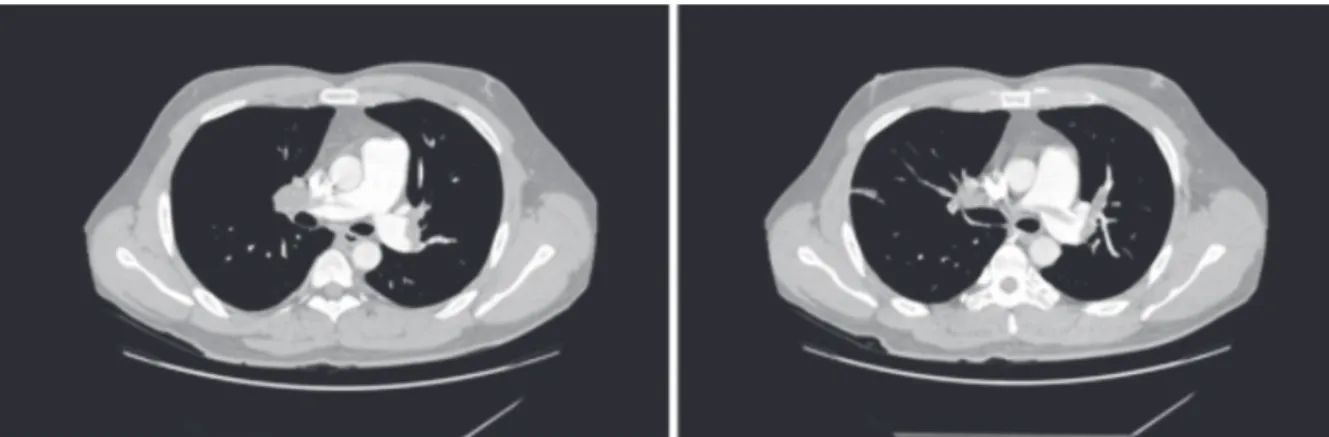 Fig. 1. Chest computed tomography finding. Chest computed tomography showed low density filling defect in  both main pulmonary artery on admission day
