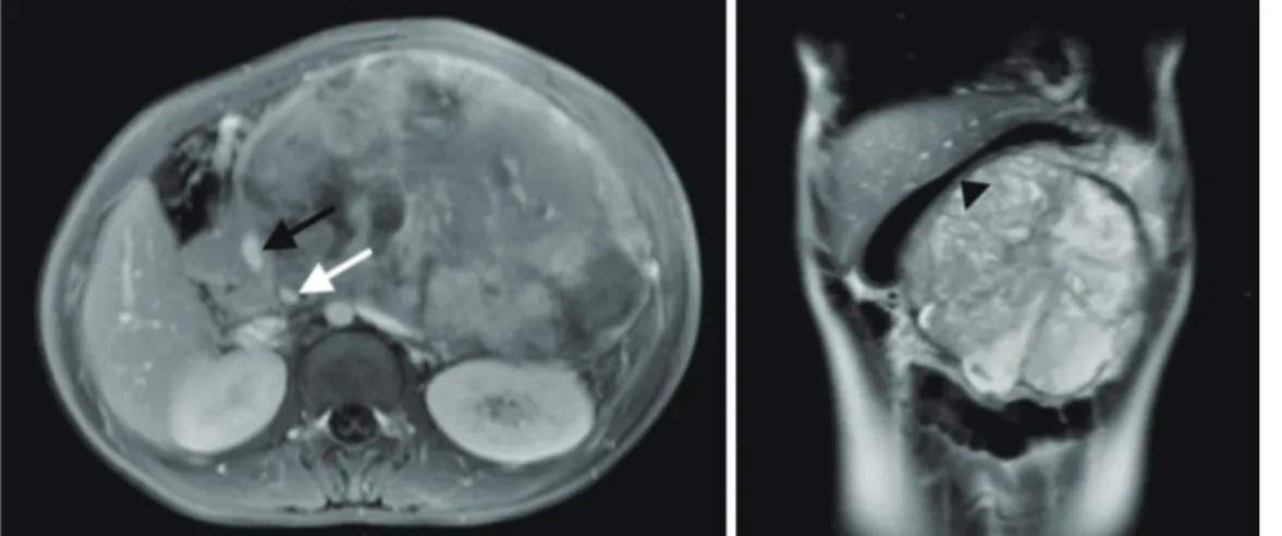 Fig. 2. PET/CT scan of torso with F-18 FDG reveals a huge, mixed density mass (156 × 107 × 131 mm) in the  LUQ, with moderate FDG uptake in the solid portion (SUVmax 6.6) and no FDG uptake in the low density  portion containing irregular calcification, whi