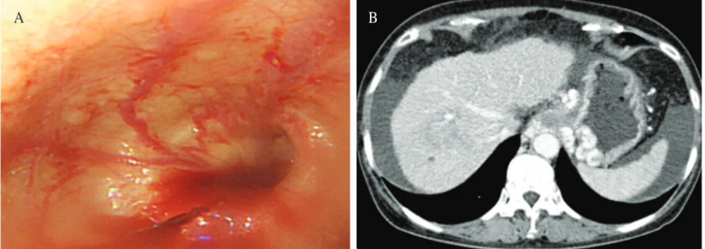 Fig. 1. Pre-procedure images. A: Upper gastrointestinal endoscopy indicating multiple linear varices and retained  blood without red color signs at lower esophagus