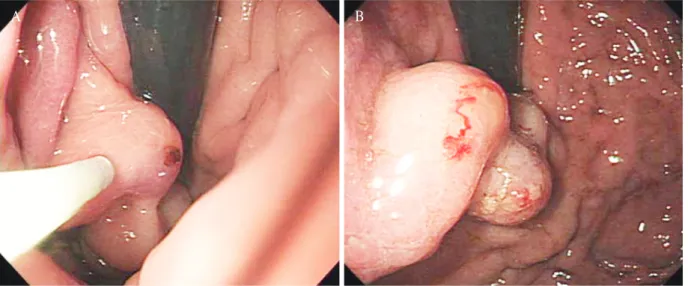 Fig. 1. Endoscopic variceal obturation was performed by injecting a total of 10 mL mixed solution of Histoacryl ® and lipiodol