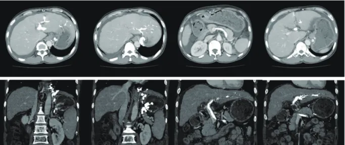 Fig. 2. In abdominal computed tomogram followed-up one month later, both intrahepatic portal vein and extrahepatic  portal vein was completely occluded by high density embolic materials which originated from gastric varices.