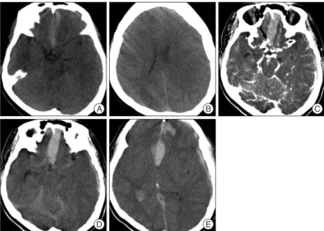Fig. 1. A : Initial plain CT scan shows thin SAH and subdural hematoma. B : There is no cavum sep- sep-tum pellucidum on the vertex cut