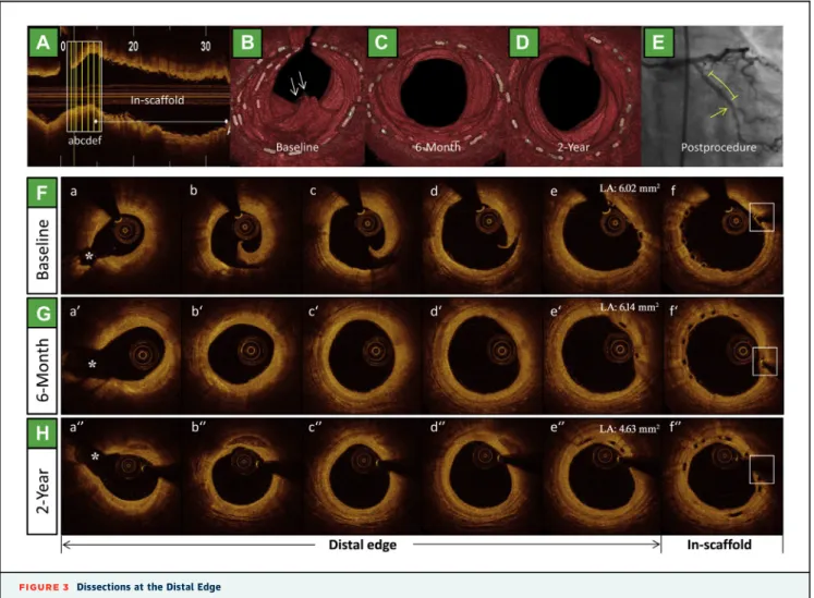 FIGURE 3 Dissections at the Distal Edge