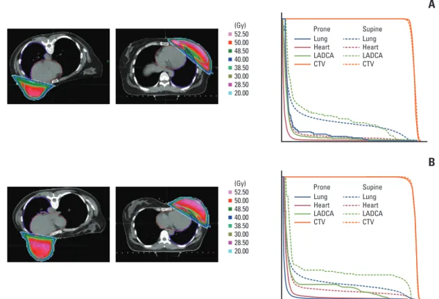 Fig. 2.  Dosimetric comparison of organs at risk between supine and prone positioning with isodose lines and dose volume
