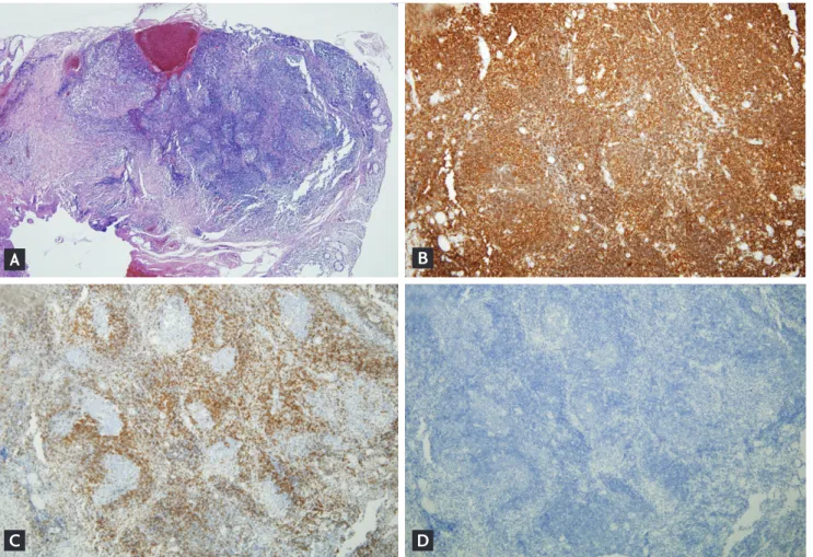 Figure 2. Histopathologic findings (×40). (A) Dense and diffuse lymphocytes and lymphoid hyperplasia are evident in the mu-