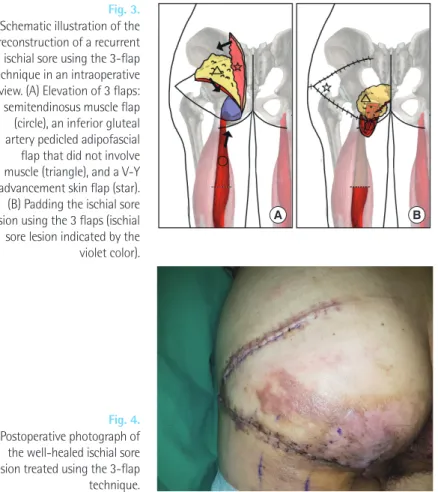 Fig. 3.    Schematic illustration of the  reconstruction of a recurrent  ischial sore using the 3-flap  technique in an intraoperative  view