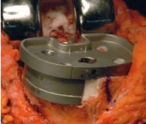 Figure 4. If the tibial blocks protrude over the cortical rim, downsized  metal blocks may be available (another case).