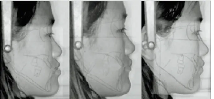 Fig. 2.  Superimposition of the cephalogram to the lateral photographic image ; preoperative, predicted and postoperative view