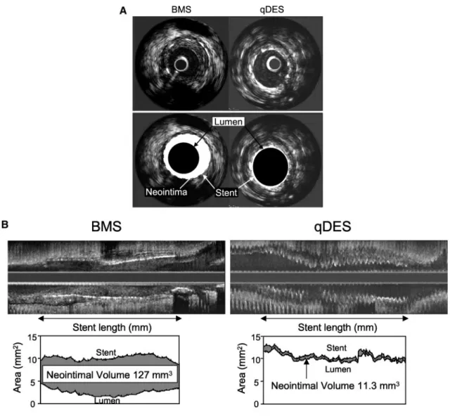 TABLE 3. Follow-Up IVUS Results